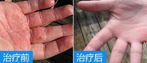 疥疮会传染吗？