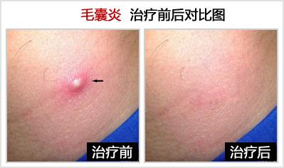 毛囊炎怎么治疗